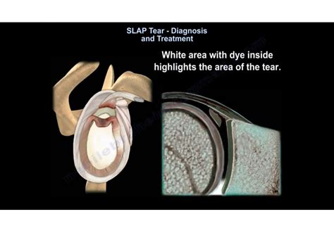 slap tear ortho tests|how to diagnose slap tears.